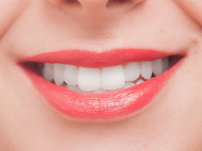 ホワイトニングとは